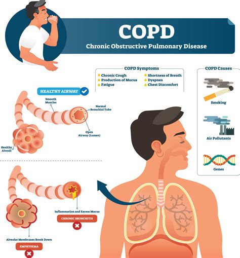 COPD .